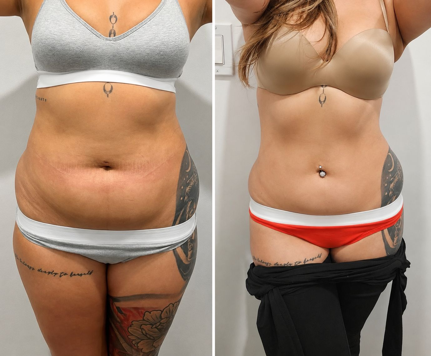 Before and after tummy transformation Client 06 at Natural Contour Clinic