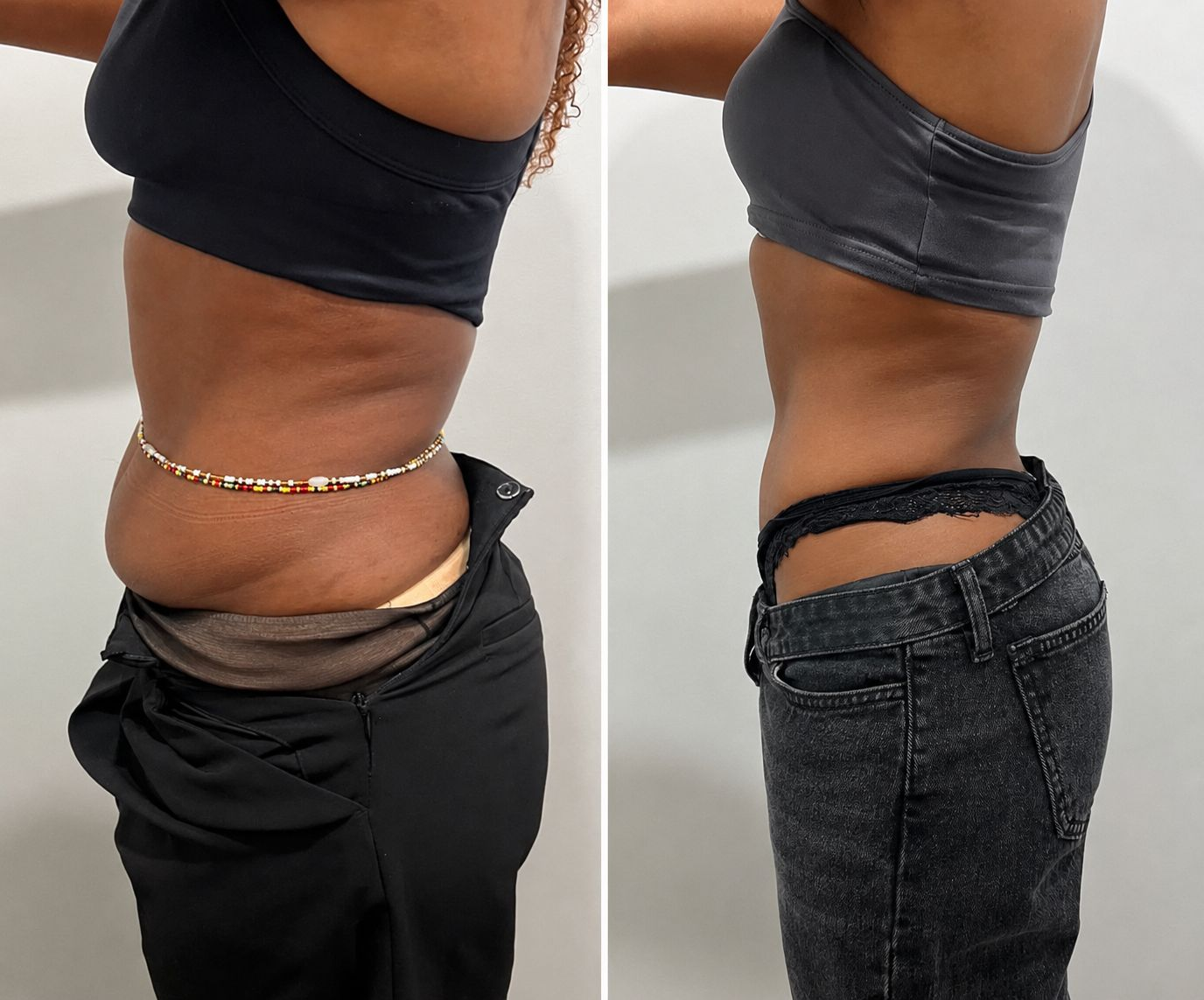 Before and after tummy transformation Client 03 at Natural Contour Clinic