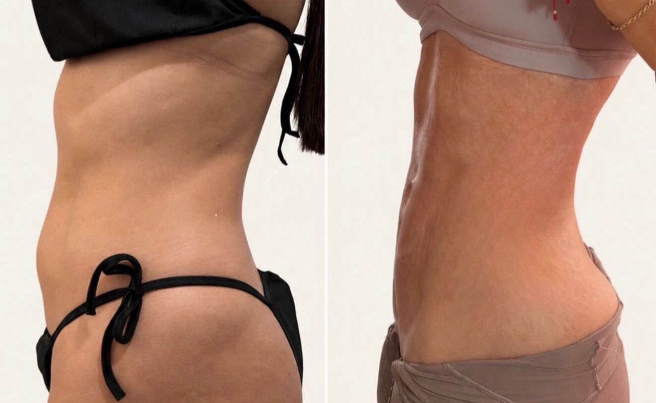 Before and after tummy transformation Client 02 at Natural Contour Clinic