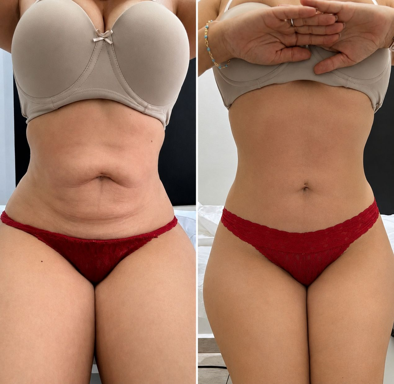 Before and after tummy transformation Client 01 at Natural Contour Clinic