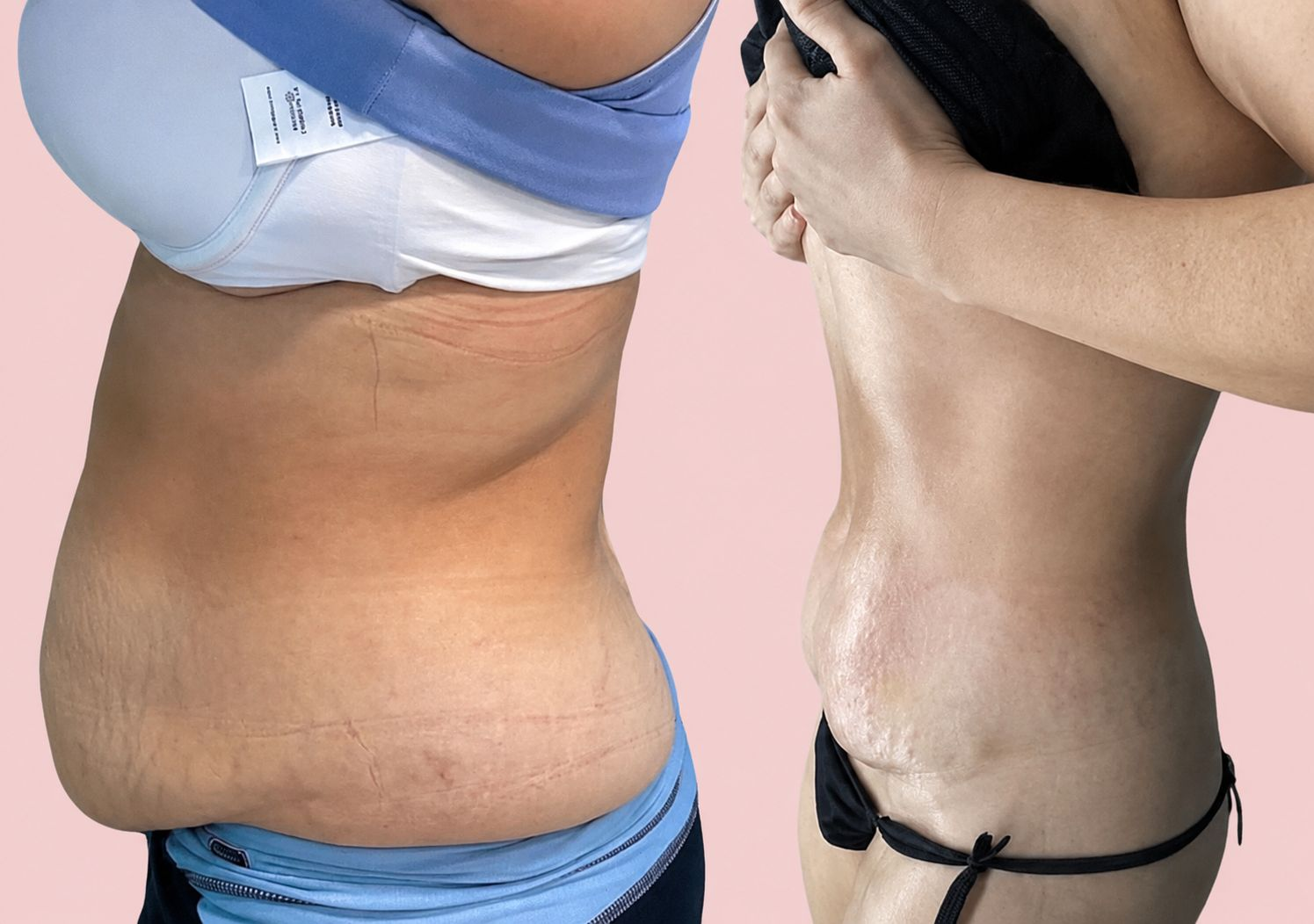Before and after tummy transformation Client 04 at Natural Contour Clinic