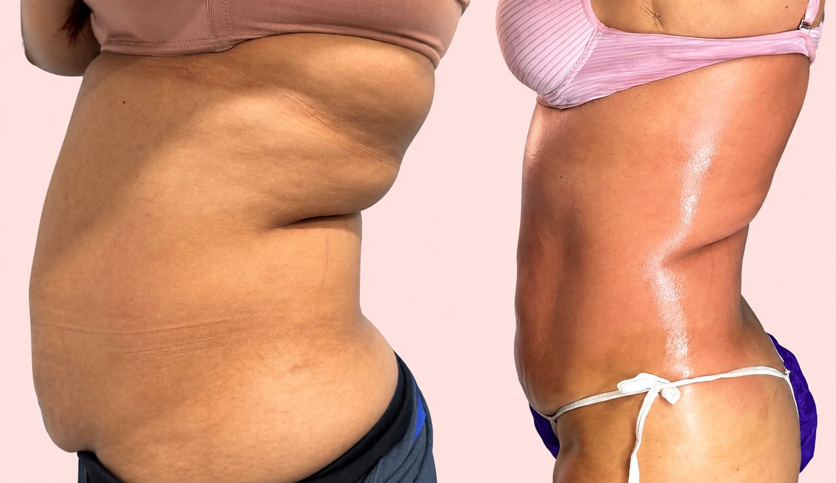 Before and after tummy transformation Client 05 at Natural Contour Clinic